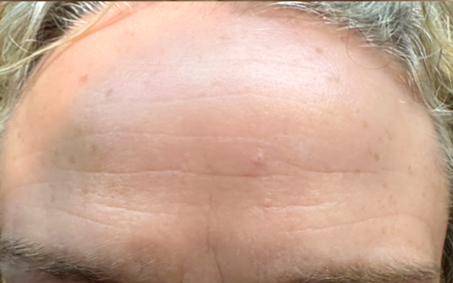 After anti-wrinkle treatment at Annayah Aesthetics Brighton