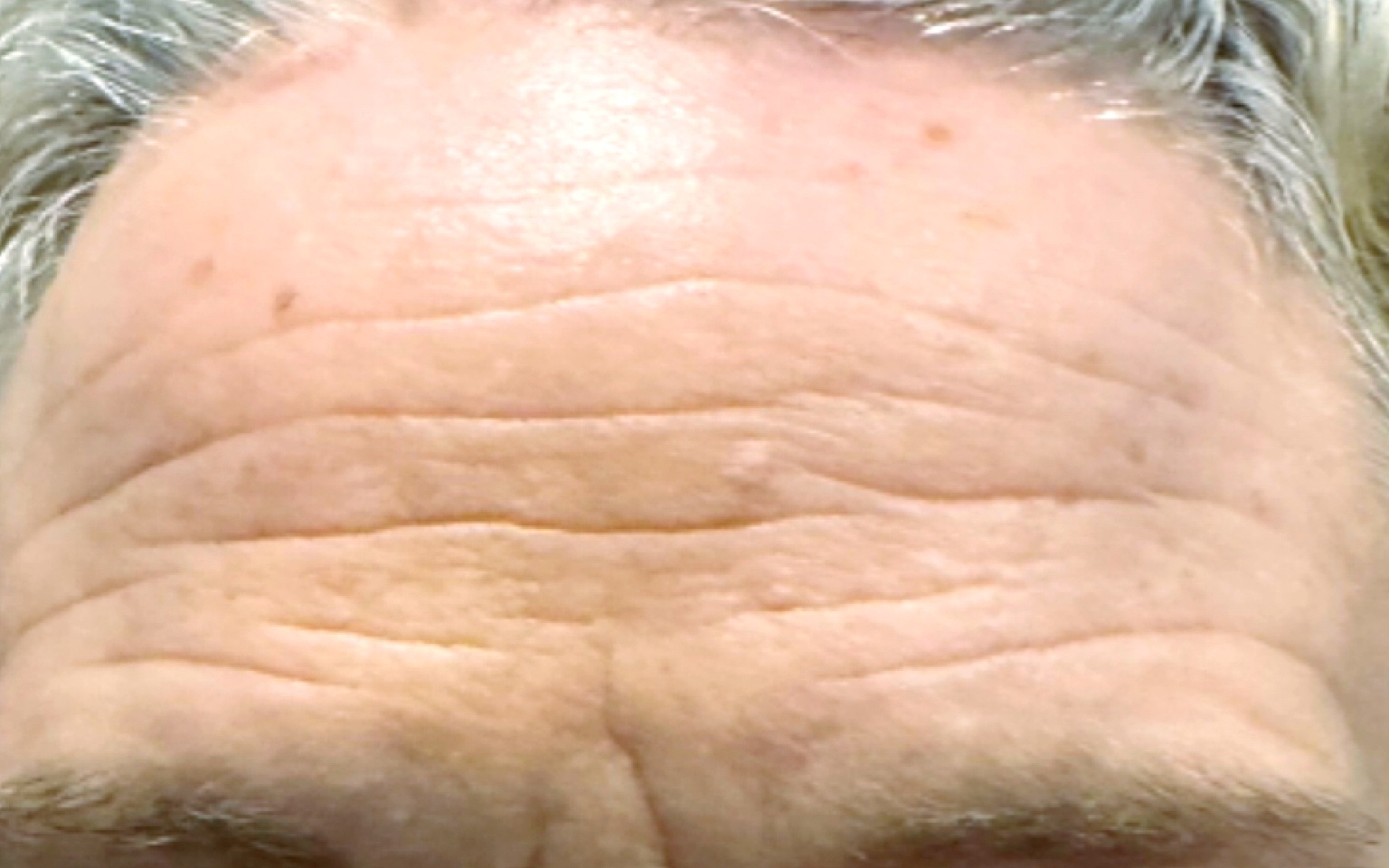 Before anti-wrinkle treatment at Annayah Aesthetics Brighton