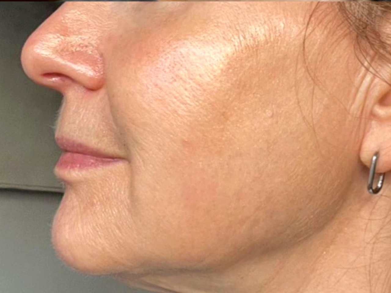 After skin rejuvenation treatments at Annayah Aesthetics Brighton