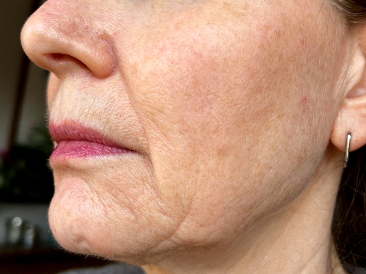 Before Profhilo skin rejuvenation at Annayah Aesthetics Brighton