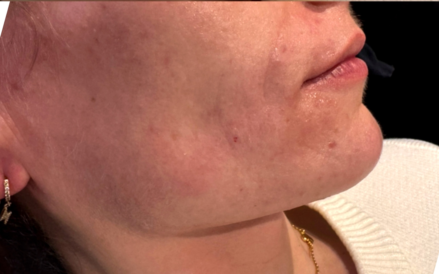 After Dermal Filler at Annayah Aesthetics Brighton