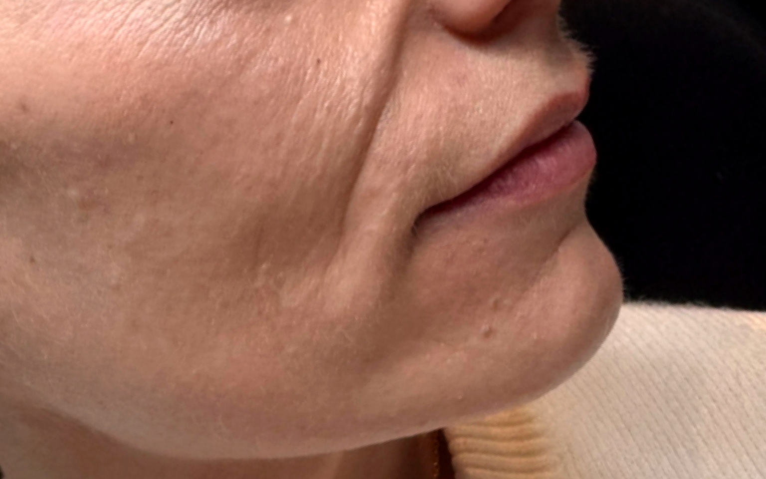 Before Dermal Filler at Annayah Aesthetics Brighton