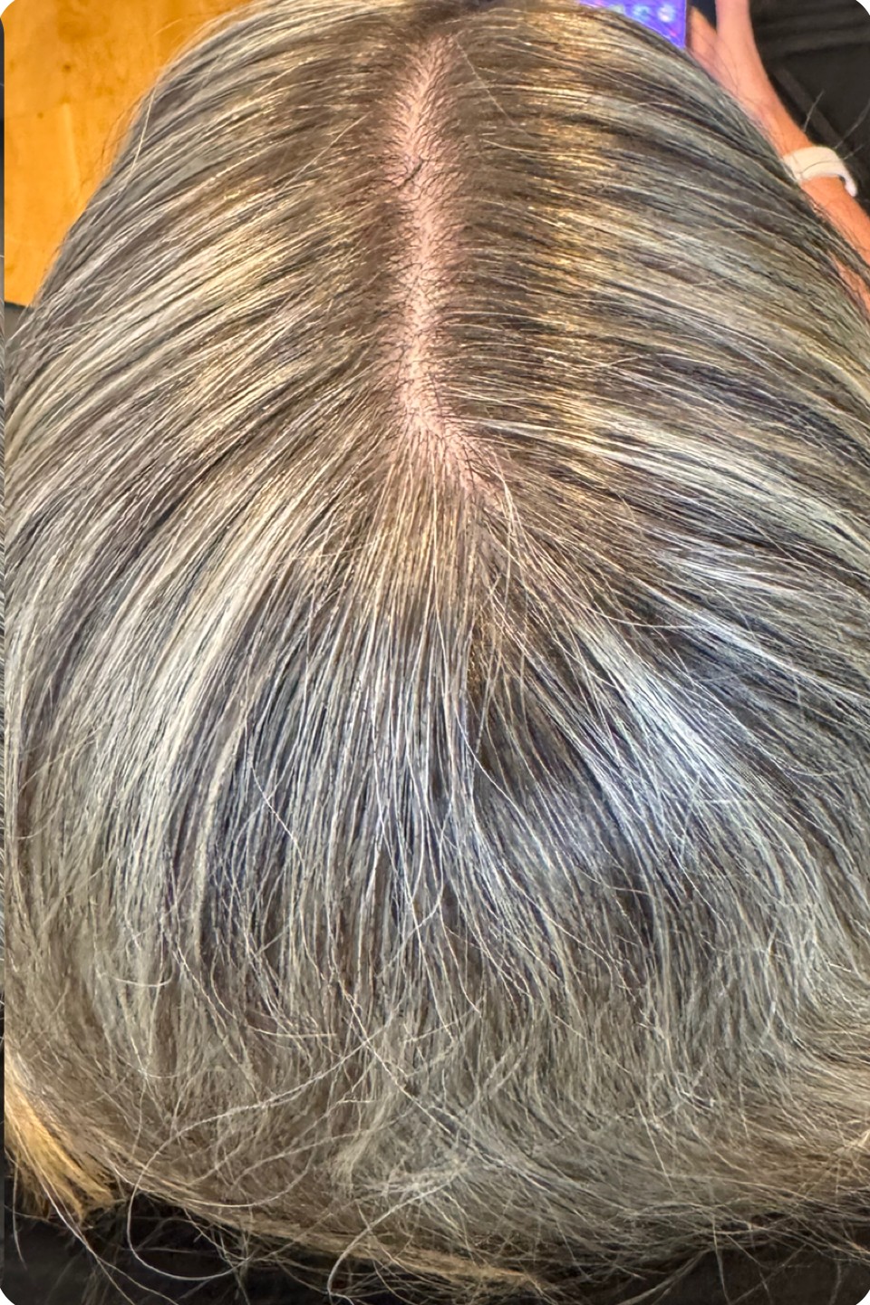 Scalp after stem signal booster hair loss treatment at Annayah Aesthetics Brighton