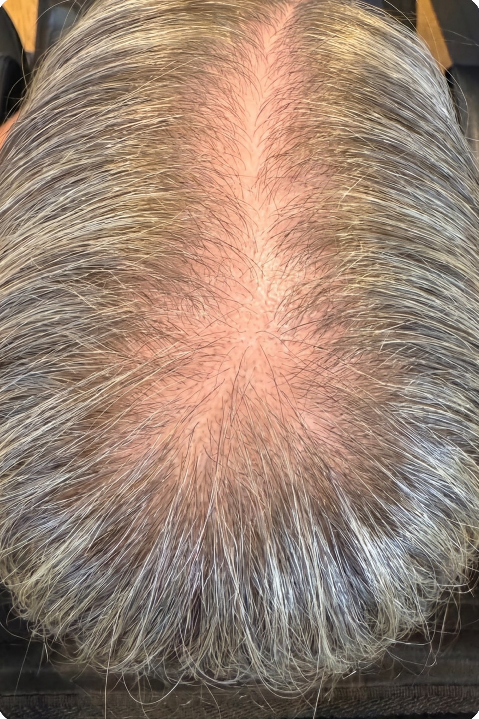 Scalp before stem signal booster hair loss treatment at Annayah Aesthetics Brighton