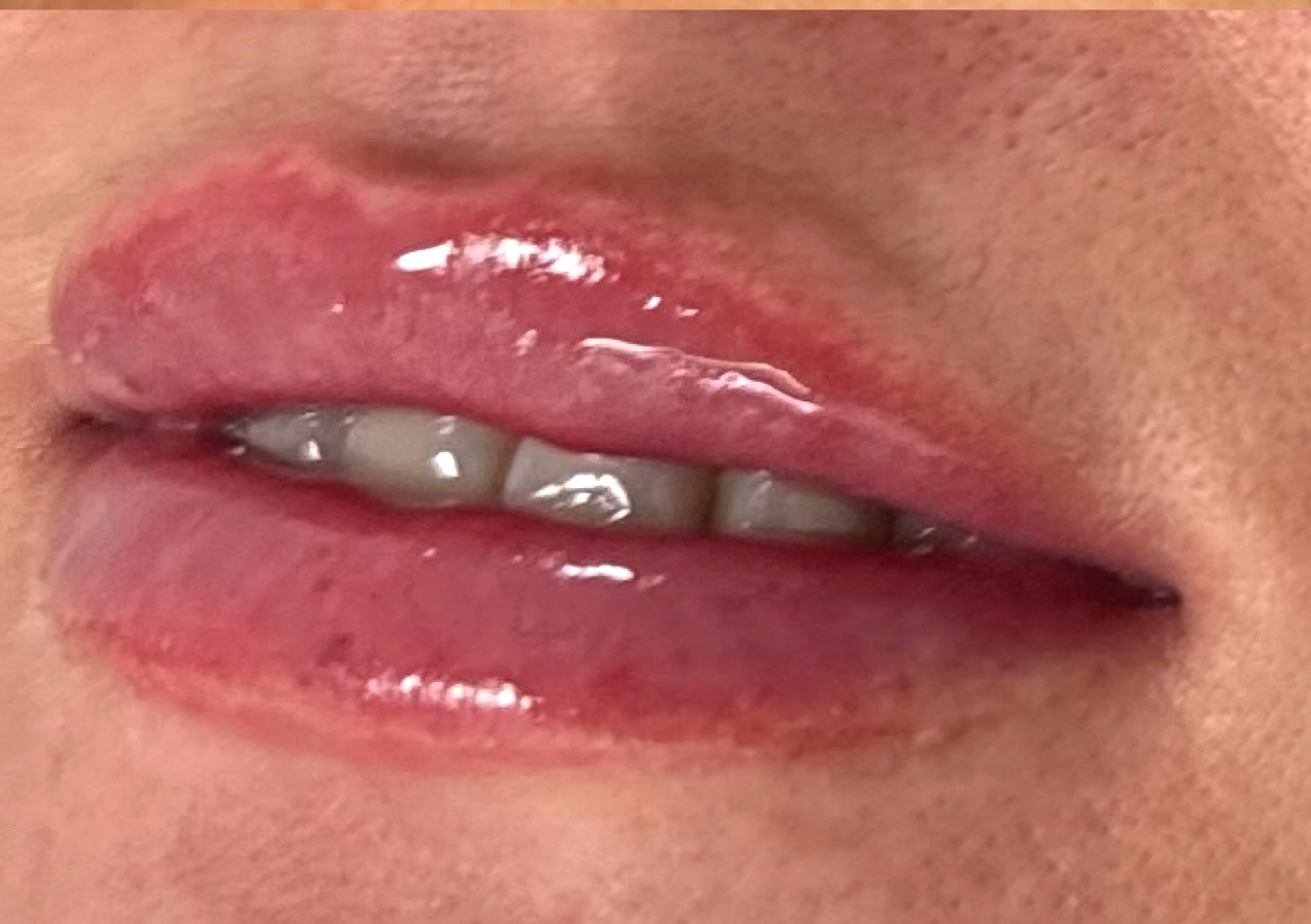 After Lip Filler at Annayah Aesthetics Brighton
