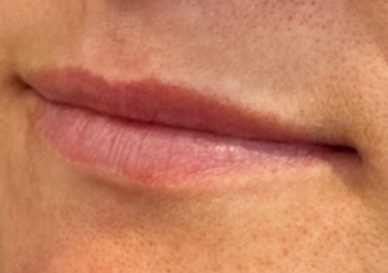 Before Lip Filler at Annayah Aesthetics Brighton