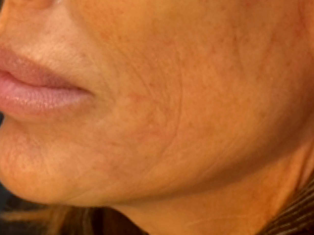 After Polynucleotides at Annayah Aesthetics Brighton