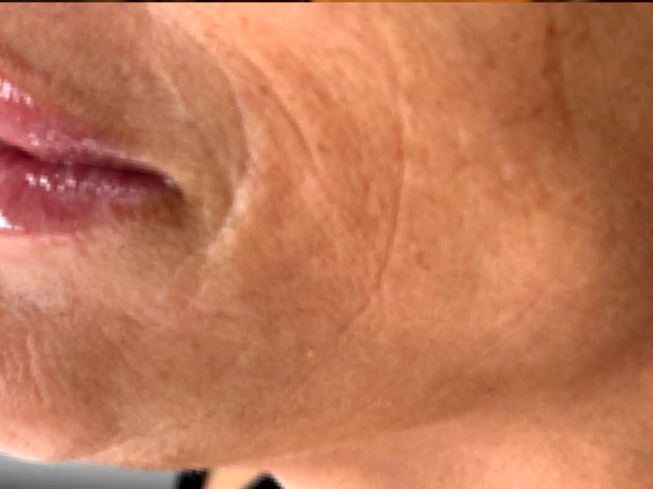 Before Polynucleotides at Annayah Aesthetics Brighton