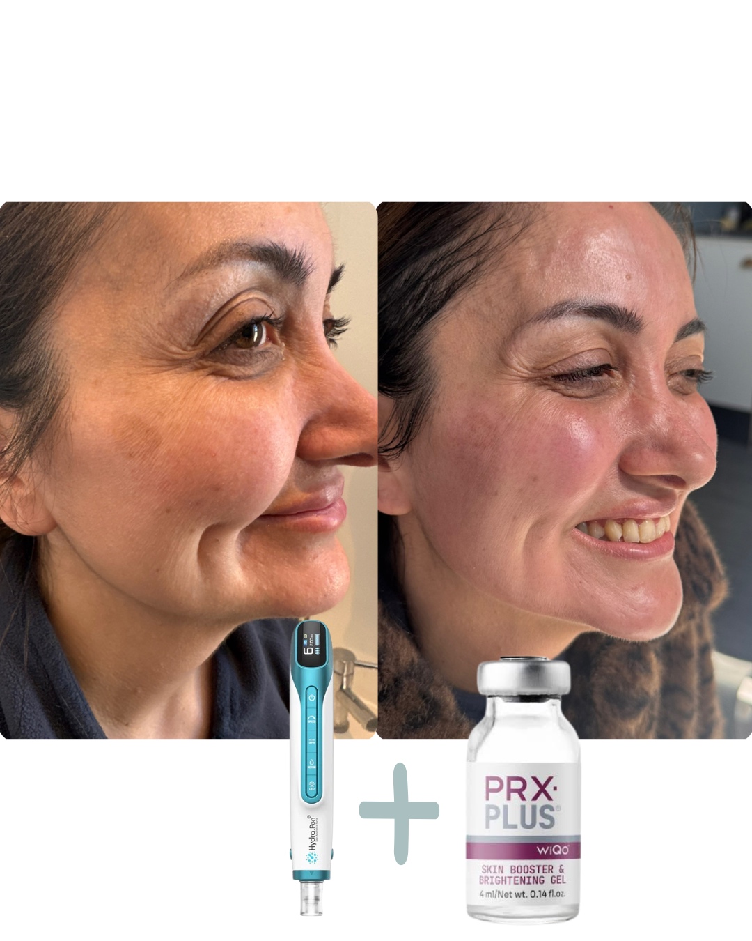 PRX Plus Facial before and after results - skin texture improvement with microneedling and PRX Plus combination