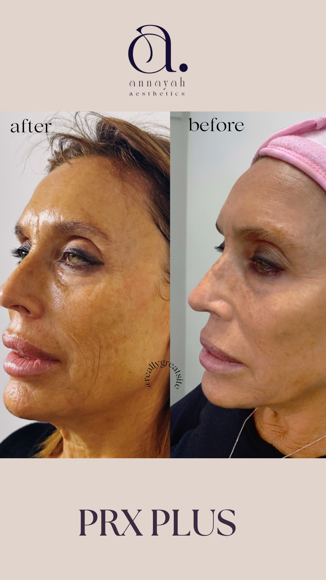 PRX Plus before and after results - visible improvement in skin firmness and radiance
