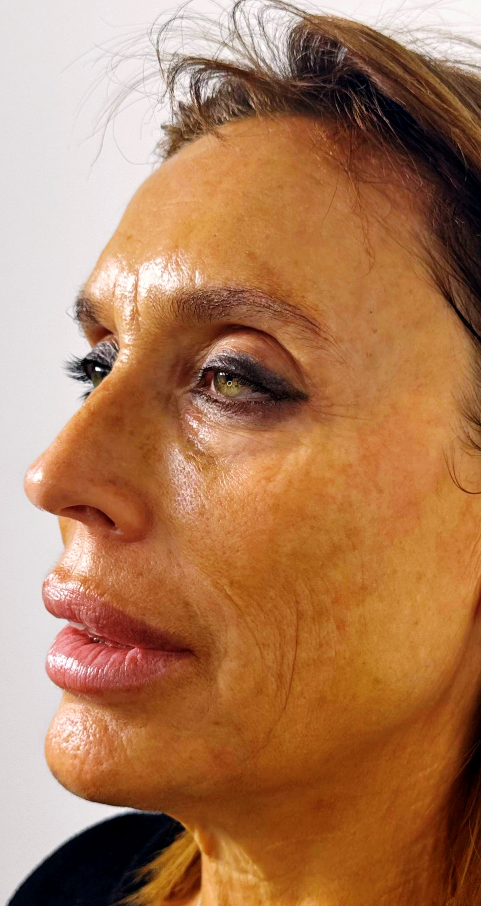 After regenerative skin treatment at Annayah Aesthetics Brighton
