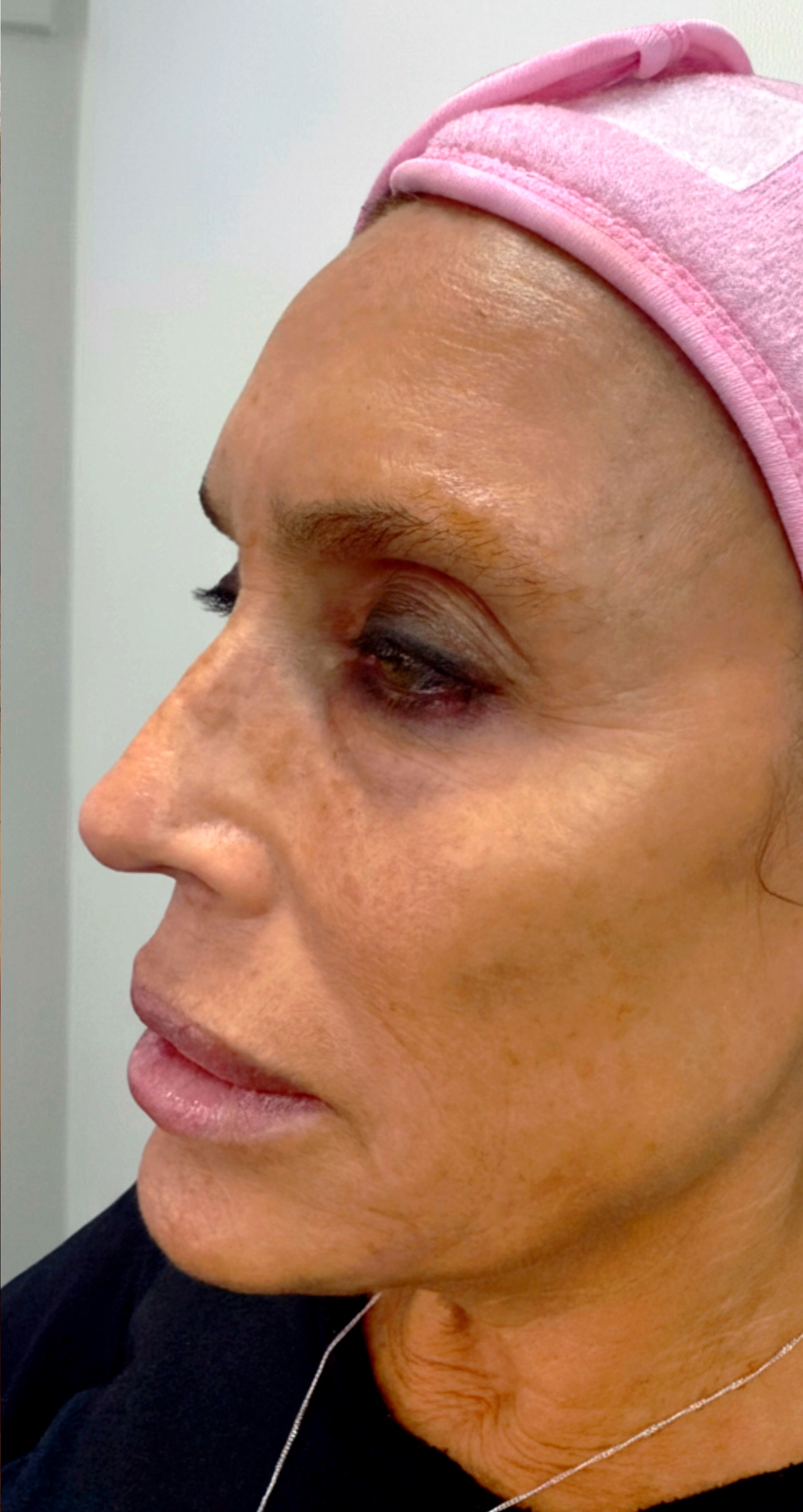 Before regenerative skin treatment at Annayah Aesthetics Brighton