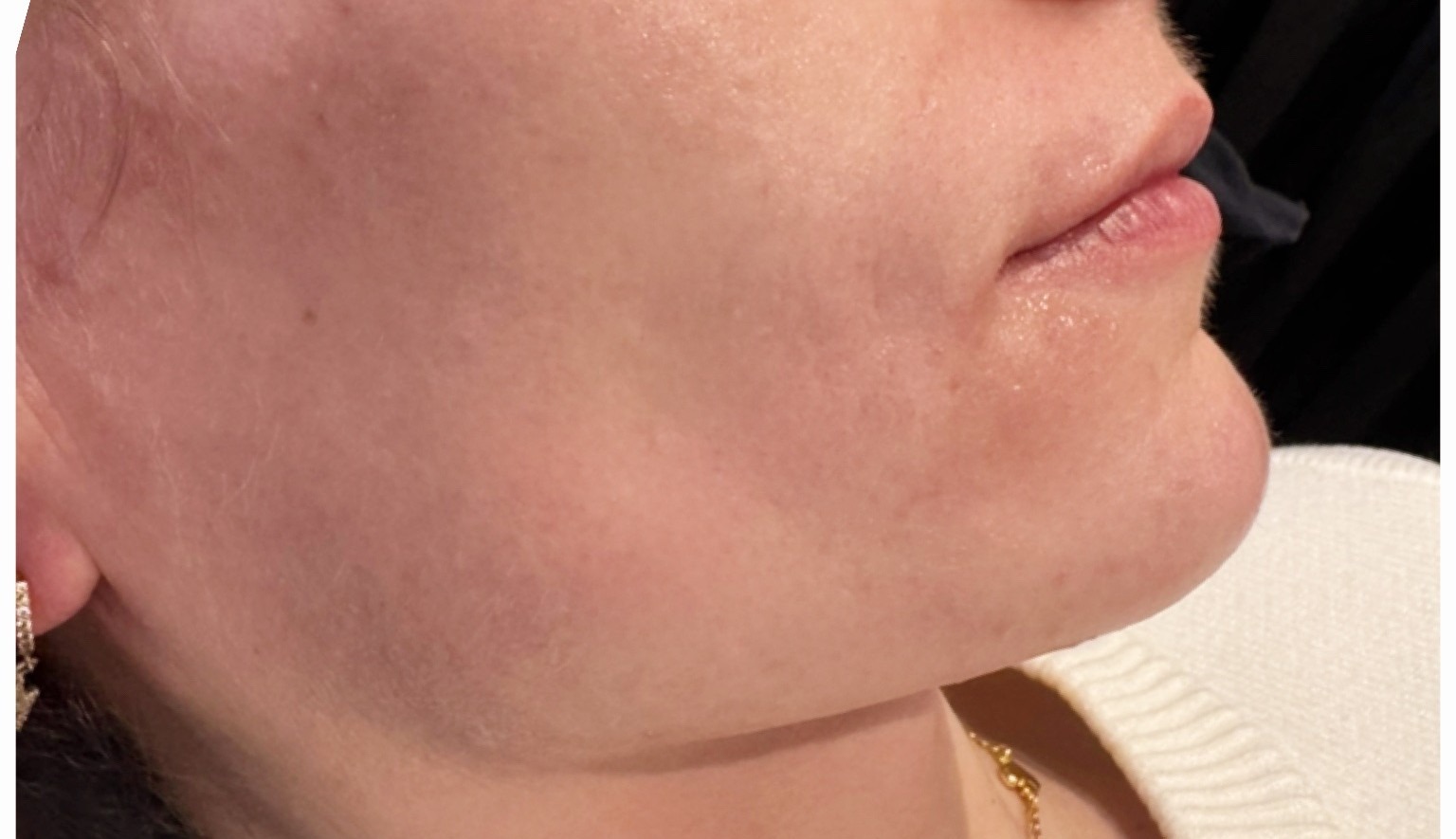 Smile lines after treatment at Annayah Aesthetics Brighton