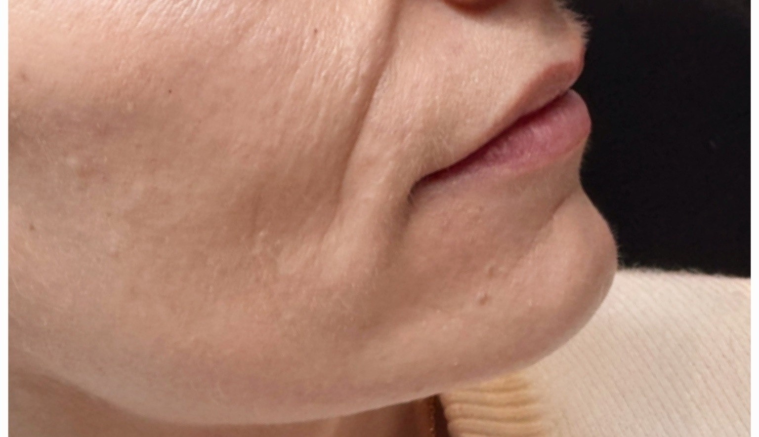 Smile lines before treatment at Annayah Aesthetics Brighton